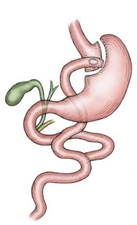 Gastric Surgery Bypass
